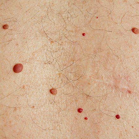 A man's back with cherry angiomas Cherry Angioma Removal, Cherry Angioma, Cancerous Moles, Liver Spot, Iodine Rich Foods, Seborrheic Keratosis, Fungal Infection Skin, Nail Problems, Skin Growths