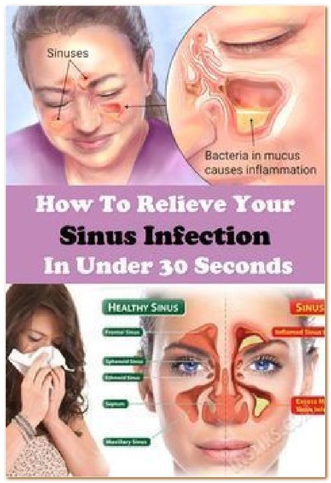 Sinus Blockage, Relieve Sinus Congestion, Clear Your Sinuses, Congestion Remedies, Blocked Sinuses, Sinus Congestion Relief, Sinus Cavities, Beauty Tips With Honey, Cold Or Allergies