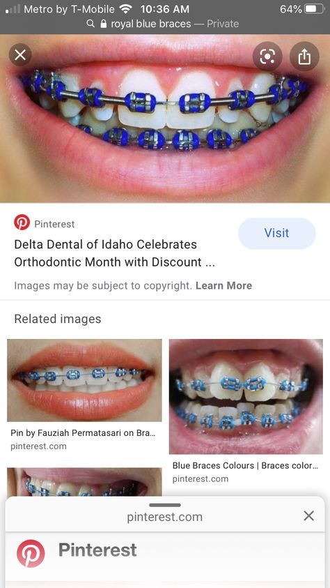 Royal Blue Braces, Braces Colours, Braces Journey, Blue Braces, Sophomore Year, Braces, Blue, Quick Saves