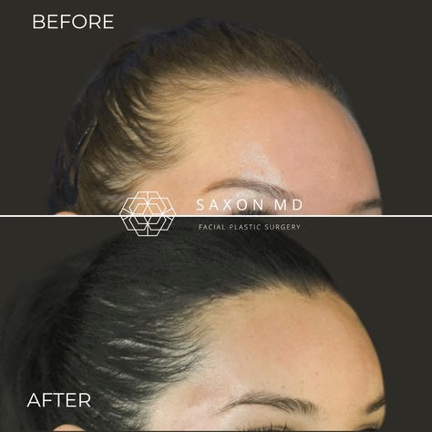 Dreaming of a more balanced facial profile? Hairline lowering (forehead reduction) can be the answer. Dr. Saxon, a leading expert in the procedure, helps patients achieve a more youthful and proportional appearance by adjusting the hairline position. This procedure reduces the forehead size with long-lasting results. #hairlinelowering #foreheadreduction #facialplasticsurgery #plasticsurgery Forehead Reduction, Facial Profile, Ipl Photofacial, Facial Proportions, Laser Skin Resurfacing, Facial Plastic Surgery, Neck Lift, Skin Resurfacing, Brow Lift