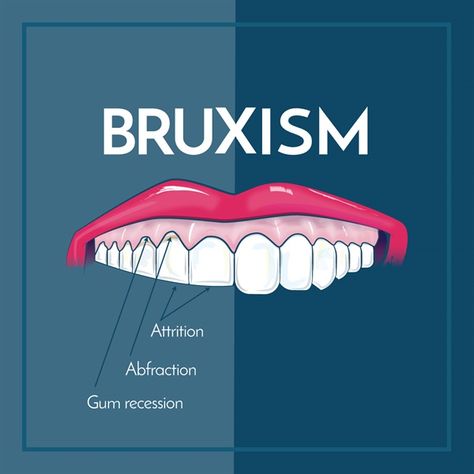 Dentaltown - Bruxism is the involuntary or habitual grinding of the teeth, typically during sleep. Excessive teeth grinding or jaw clenching causes tooth wear and breakage. Dental Advertising, Dental Posts, Dental Posters, Jaw Clenching, Dental Hygiene School, Gum Recession, Dental Fun, Teeth Grinding, Dental Facts