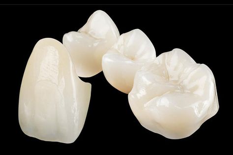 From San Diego, CA. Do you have chipped, cracked, stained, or decayed teeth? Ceramic crowns protect and improve your dental aesthetics. Porcelain Crowns, Dental Restoration, Dental Aesthetics, Partial Dentures, Teeth Shape, Dental Bridge, Family Dental, Natural Teeth, Dentures