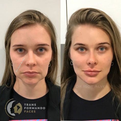 Before/after facial transformation with dermal filler. What do you think? Comment ⬇️ . . This procedure was performed by @igoorcostalves .… Face Fillers, Face Surgery, Cheek Fillers, Facial Fillers, Facial Contouring, Skin Care Routine 30s, Facial Aesthetics, Cosmetic Dermatology, Aesthetic Medicine