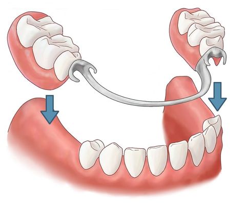 Denture Adhesive, Tooth Repair, Dental Health Care, Dental Implants Cost, Partial Dentures, False Teeth, Laser Teeth Whitening, Tooth Replacement, Teeth Implants