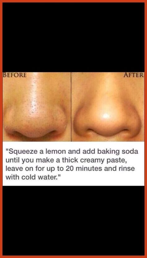 Homemade Acne Remedies, Exposed Skin Care, Black Heads, Natural Acne, Nail Care Tips, Homemade Beauty, Acne Remedies, Skin Pores, Skin Care Treatments