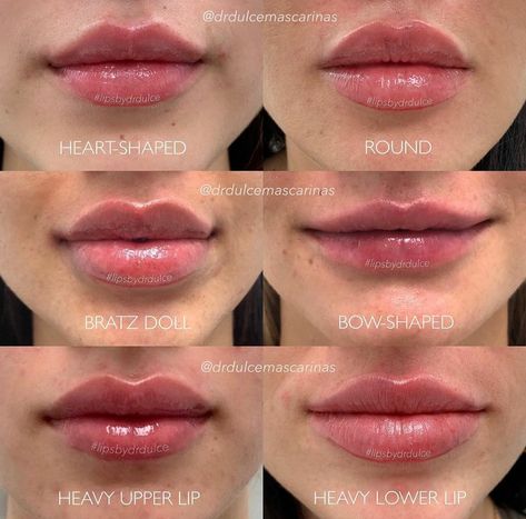 Gaun Koktail, Lips Inspiration, Face Fillers, Botox Lips, Being Unique, Facial Fillers, Facial Aesthetics, Lip Filler, Botox Fillers