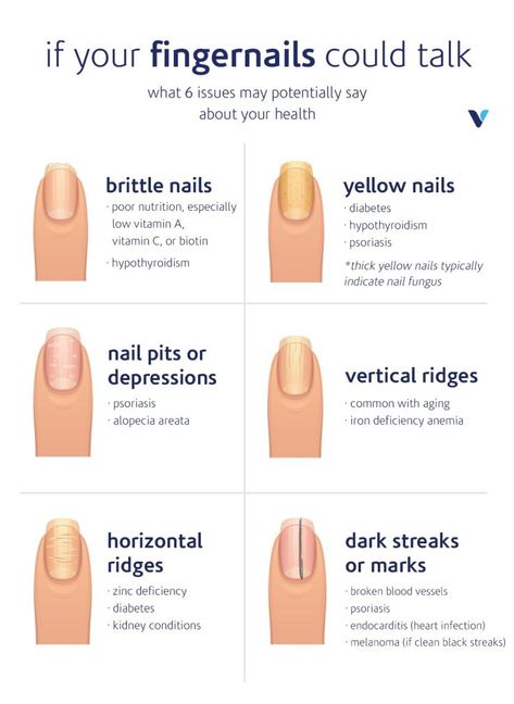 Fingernail Health, Calendula Benefits, Matcha Benefits, Lemon Benefits, Poor Nutrition, Coconut Health Benefits, Stomach Ulcers, Brittle Nails, Benefits Of Coconut Oil