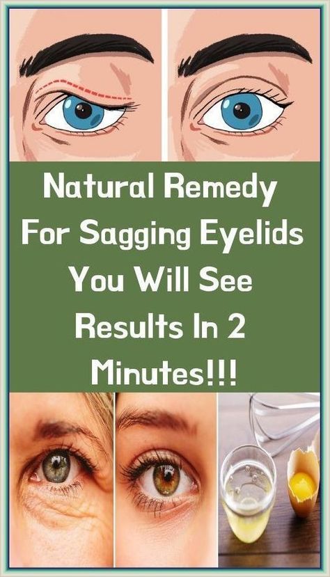 Natural Remedy for Sagging Eyelids-You Will See Results in 2 Minutes! Sagging Eyelids, Droopy Eyelids, Diy Remedies, Natural Therapy, Natural Diy, Natural Remedy, Natural Home Remedies, Holistic Health, Home Remedies