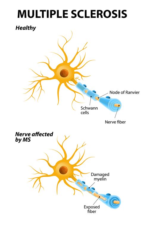 Multiple Sclerosis is a long-lasting disease that can affect your brain, spinal cord, and the optic nerves in your eyes. It can cause problems with vision, balance, muscle control, and other basic body functions. #MSawareness Ms Disease, Guillain Barre, Guillain Barre Syndrome, Body Functions, Ms Project, Optic Nerve, Nerve Fiber, Ms Awareness, Multiple Sclerosis Awareness