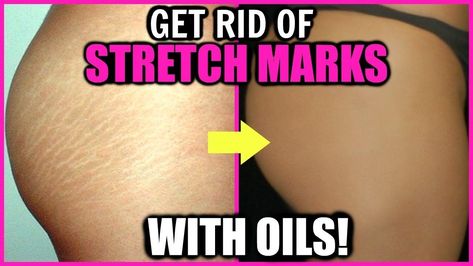 Strech Marks, Stretch Mark Remedies, Stretch Mark Removal, Stretch Mark Cream, Stretch Mark, Rosehip Seed Oil, Best Oils, Skin Health, Smooth Skin