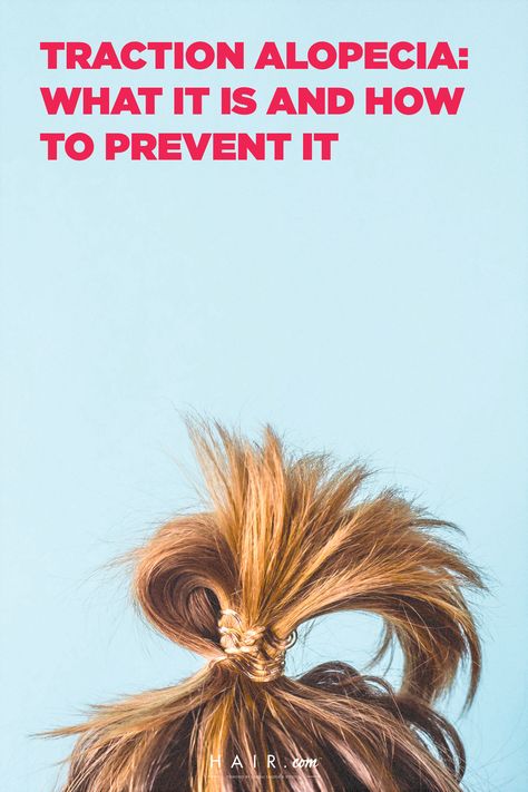 Despite the popular saying, having "snatched" hair isn’t always a good thing. The excessive pulling, brushing, and tugging required to create some of our favorite hairstyles could lead some of us to experience a type of hair loss known as traction alopecia. To find out more about this condition and how to prevent it, check out our full article on hair.com! Tension Alopecia, Alopecia Hairstyles, Traction Alopecia, Male Pattern Baldness, Pattern Baldness, Female Male, Popular Quotes, Favorite Hairstyles, Body Hair