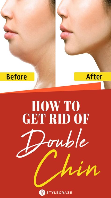 Too much chubbiness, especially around the jaws, is a clear indication of fat accumulation, and it is referred to as a double chin. It is not only alarming, but also downright embarrassing. Here are a few home remedies and simple exercises that can help you get rid of a double chin. #health #fitness #DoubleChin #Remedies Get Rid Of Saggy Skin, Tighten Stomach, Rid Of Double Chin, Jawline Exercise, Double Chin Removal, Skin Tightening Stomach, Double Chin Exercises, Reduce Double Chin, Chin Exercises