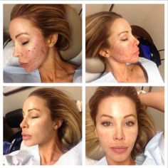 ‘RHOM’ Star Lisa Hochstein Gets Vampire Facial – From Her Husband! | Radar Online Facial Before And After, Lisa Hochstein, The Greenhouse Effect, Hair Growth Rate, Bio Oil Skin, Facial Aging, Vampire Facial, Makeup Free, Greenhouse Effect