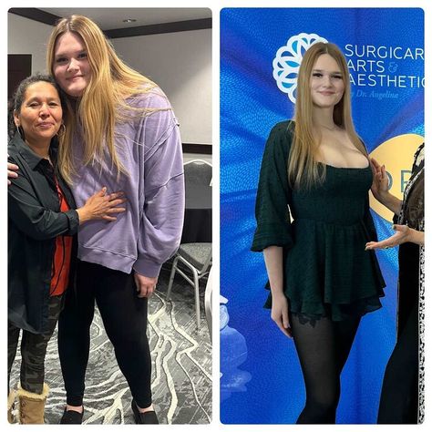 These Ozempic Before and After Photos Give a Real-Life Glimpse of What Life is Like on Weight Loss Medication — Parade Kylie Before And After, Semaglutide Before And After Results, Victoza Before And After, Glp1 Before And After, Ozempic Face Before And After, Metformin Before And After, What Foods To Eat While On Ozempic, Ozempic Before And After Photos, Semiglude Before And After