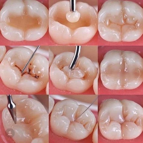 Dental Pictures, Dental Assistant Study, Dental Hygiene Student, Dental Jewelry, Dental Aesthetics, Dental Restoration, Kedokteran Gigi, Dental Videos, Dental Hygiene School