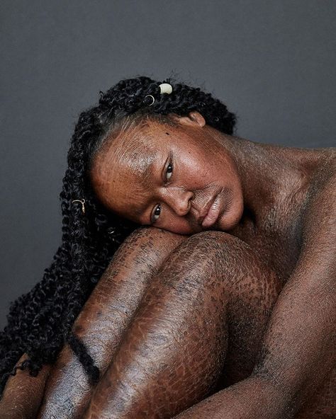 Woman Who Sheds Skin Every Two Weeks Becomes Probably The First Model Who Has This Condition | Bored Panda How To Tie Bandana, Lots Of Makeup, Becoming A Model, American Poets, Skin Disorders, Deep Conditioning, Double Chin, Shooting Photo, Vogue Italia