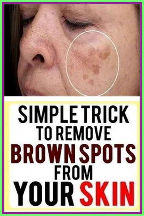 Face Brown Spots Removal - The Right Choice? by Dusan Canevski | This newsletter was created with Smore, an online tool for creating beautiful newsletters for educators, nonprofits, businesses and more Age Spot Removal, Brown Spots On Skin, Brown Spots Removal, Brown Spots On Face, Skin Spots, Spots On Face, Baking Soda Shampoo, Remove Dark Spots, Skin Remedies