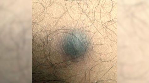 Hard lump under the skin: Causes and pictures Lancing A Boil, Holes In Skin Phobia, Trypophobia Skin, Boil Popping Videos, Cheek Pimples, Skin Disease Pictures, Skin Boil, Human Skin Texture, Pimples On Buttocks