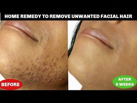 #Khichibeauty #khichibeautytipsGET RID OF UNWANTED FACIAL HAIR AT HOME, REMOVE CHIN HAIR + UPPER LIPS, NO SHAVE NO WAX25 DAYS SKINCARE CHALLENGE PLAYLISTht... Skincare Challenge, Waxing Vs Shaving, Natural Hair Removal Remedies, Chin Hair Removal, Female Facial Hair, Upper Lips, Bump Hairstyles, Upper Lip Hair, Face Hair Removal