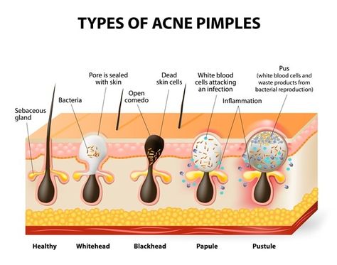 Nodular Acne, Different Types Of Acne, Skin Anatomy, Forehead Acne, Skin Facts, Acne Vulgaris, Types Of Acne, Acne Causes, Hormonal Acne