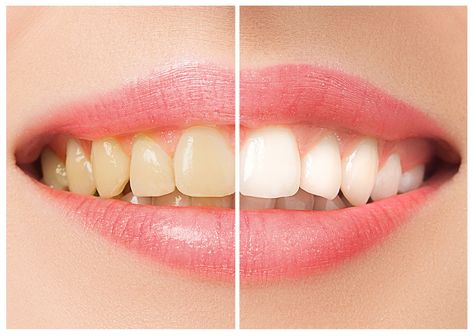 Dental Bleaching, Cosmetic Dentistry Procedures, Discolored Teeth, Teeth Bleaching, Nice Teeth, Dental Bridge, Dental Crowns, Dental Surgery, Dental Problems