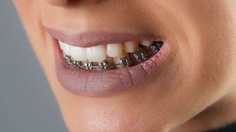 Bottom Teeth Braces, Permanent Retainer, Braces Before And After, After Braces, Braces Cost, Bottom Teeth, Straight Smile, Invisalign Aligners, Invisible Braces