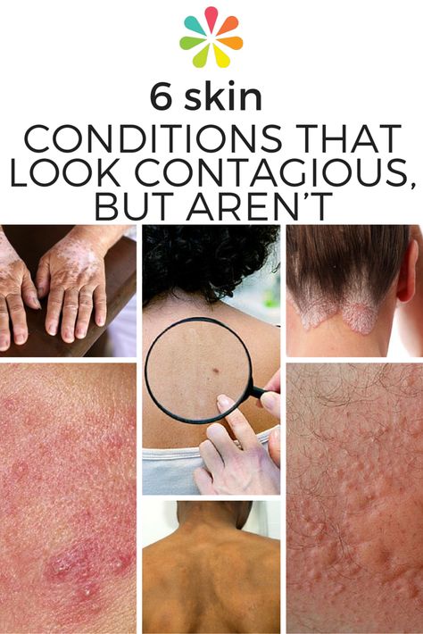 In reality, many of the most common skin conditions aren’t the least bit contagious. #skinhealth #contagiousconditions #stayhealthy #everydayhealth | everydayhealth.com Skin Conditions Pictures, Skin Rashes Pictures, Skin Rash On Face, Skin Rash Remedies, Intimate Wash, Home Remedies For Skin, Health Chart, Skin Facts, Skin Disorders