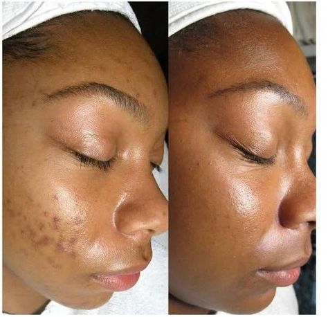 Resultados skincare 
Benefícios skincare 
Aesthetic skin
Better skin 
Spring 🌼
Cuidados com a pele
SKINCEPTION Before And After Skincare, Acne Holes, Hyperpigmentation Mask, Aloe Face Mask, Skin Hyperpigmentation, Skincare Benefits, Prevent Ingrown Hairs, Brazilian Waxing, Skin Discoloration