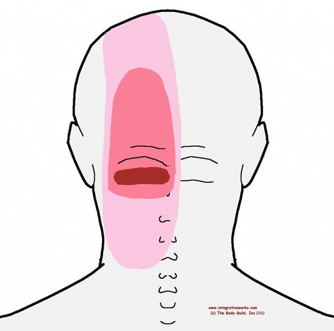 Headache at the base of your head | Integrative Works Headache Back Of Head, Head Pain Relief, Forward Head Posture Exercises, Natural Headache, Severe Back Pain, Anatomy Medical, Natural Headache Remedies, Back Of Head, Head Pain