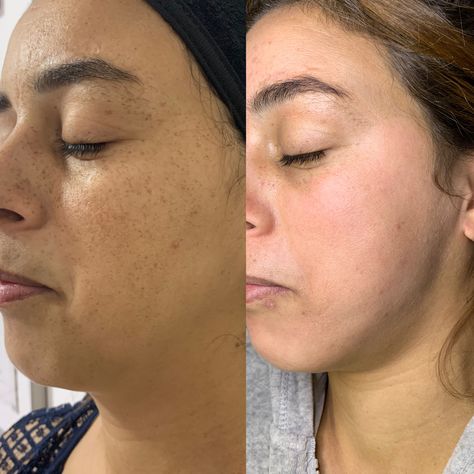 Result Treatment For Pigmentation Sunspots After A Month Before And After Acne, Skin Facts, Open Pores, Before After, Basic Skin Care Routine, Facial Exercises, Beauty Center, Skin Blemishes, Instagram My Story