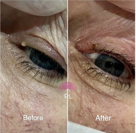 How do you get rid of milia on eyelids? Here's how... Get Rid Of A Stye Overnight, How To Remove Milia Under Eyes, Oily Eyelids How To Get Rid Of, How To Get Rid Of Milia Under Eyes, How To Get Rid Of Milia On Face, Milia Removal Remedies, Milia Removal Diy, Millia Removal, White Bump On Eyelid