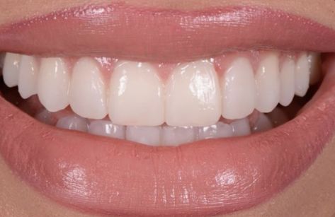 Pretty Teeth Aesthetic, Teeth Claims For Dr, Perfect Smile Aesthetic, Pretty Smile Aesthetic, Dream Teeth, Smile White Teeth, Smile Tips, Teeth Aesthetic, Pretty Teeth