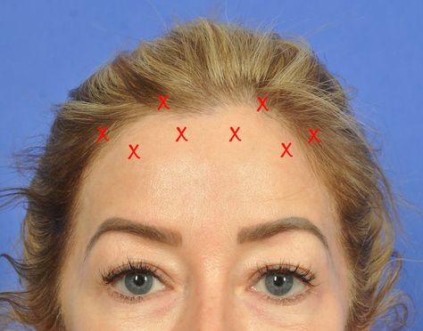 Botox Forehead Injection Sites, Botox Face Mapping, Botox Areas On Face, Botox Brow Lift Before And After, Botox Placement, Botox Mapping, Face Injections, Botox Forehead, Botox Injection Sites