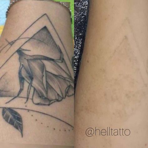 tattoo removal before and after Laser Tattoo Removal Before And After, Aged Tattoos Before And After, Tattoo Removal Before And After, Tattoo Removal Cost, Vintage Style Tattoos, Traditional Style Tattoo, Free Tattoo Designs, Saved Tattoo, Facial Aesthetics