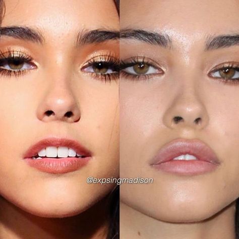 Madison Beer eyebrow lift, foxy eye surgery, cheek fillers, jaw surgery, nose lift, face lift, alarplasty Madison Beer Plastic Surgery, Madison Beer Makeup, Face Plastic Surgery, Lip Flip, Lips Inspiration, Facial Surgery, Eyebrow Grooming, Permanent Cosmetics, Honey Brown Hair