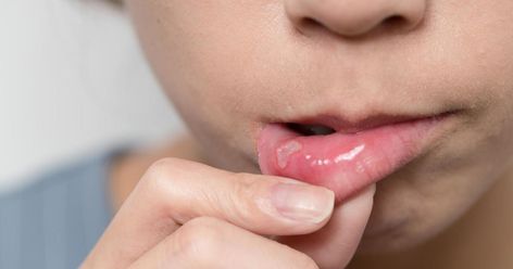 4 Tips To Avoid Mouth Ulcers Canker Sore Causes, Crohns Diet, Tongue Sores, Gluten Free Tips, Canker Sore, Cold Sores, Receding Gums, Gluten Sensitivity, Nursing Tips