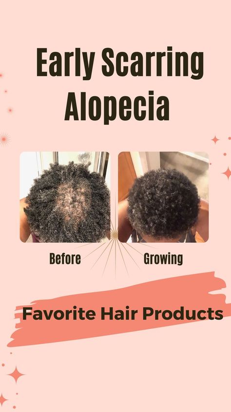 Natural Hair 4c Hairstyles, Hairstyles 4c Natural Hair, Alopecia Hairstyles Black Women, Hair Care 4c, Natural Hairstyles 4c, 4c Natural Hairstyles, Natural Hair 4c, Scarring Alopecia, Alopecia Hair Growth