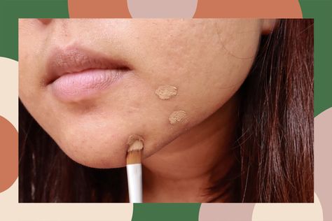 White Bumps On Face, How To Cover Pimples, Red Spots On Face, Cover Pimples, Cover Up Pimples, Huge Pimple, Inflamed Pimple, Redness Pimple, Covering Acne