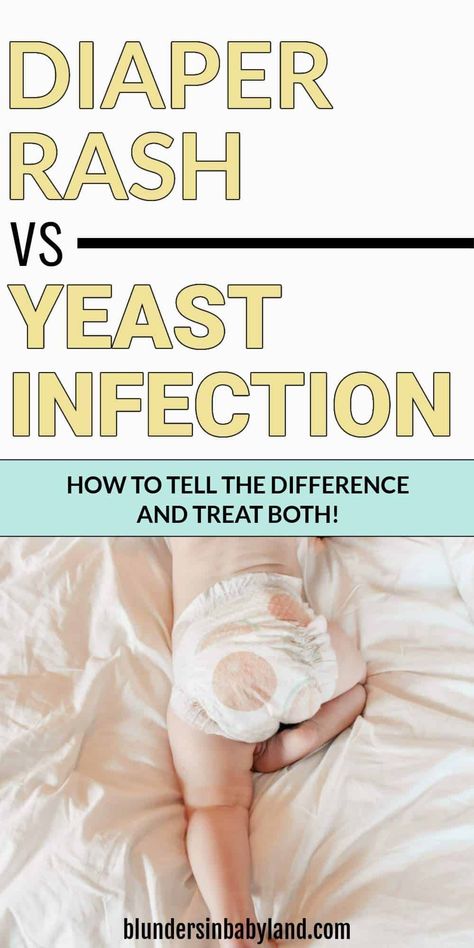 When treating your baby's diaper rash, it's important to know exactly what you're dealing with. This post shows how to tell the difference between diaper rash vs yeast infection...plus the best yeast rash remedies and diaper rash remedies Nappy Rash Remedies Natural, Yeast Rash Remedies Baby, Diaper Rash Remedy Severe, Toddler Yeast Infection, Natural Diaper Rash Remedies, Baby Rashes, Home Remedies For Rashes, Rash Remedies, Diaper Rash Remedy