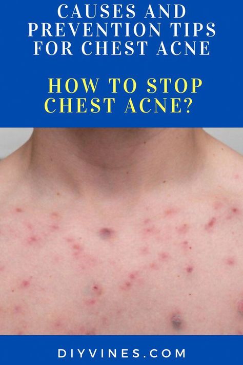 Are you searching for how to stop chest acne? Chest acne can range in appearance from a few red pimples and spots to weeping pustules, blackheads, whiteheads and even cysts. Chest Acne Remedies, Pustules Acne, Peroxide For Acne, Redness Pimple, Cystic Acne Remedies, Clear Skin Routine, Chest Acne, Blind Pimple, Get Rid Of Pimples