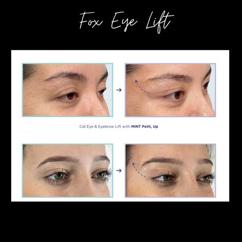 Fox Eye Thread Lifts - Everything you wanted to know about them and why they have always been trendy. Eye Thread Lift, Elite Aesthetics, Anti Wrinkle Injections, Tear Trough, Cheek Fillers, Thread Lift, Fox Eyes, Dermal Fillers, Lip Fillers