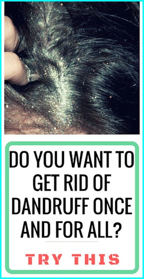 Get Rid Of Dandruff In 7 Natural Ways That You Should Apply Rid Of Dandruff, Getting Rid Of Dandruff, Dandruff, Almond Oil, Natural Remedies, Coconut Oil, Click Here, Read More, How To Apply