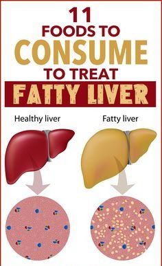 Evidence-Based Fatty Liver Diet – Diet Plan And Foods To Eat And Avoid: Many fatty liver patients do not show signs and symptoms until it’s too late. That’s why you should be extra cautious and improve your diet and lifestyle. Here are some foods and a diet plan that can protect you from fatty liver. #Health #Wellness #HealthCare Liver Diet Plan, Liver Diet Recipes, Healthy Liver Diet, Natural Liver Detox, Me In 2023, Health Women, Liver Diet, Healthy Plan, Essay Writing Skills