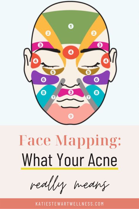 Acne Face Mapping, Chinese Face Map, Acne Chart, Cheek Acne, Face Map, Skin Mapping, Chin Acne, Acne Tips, Face Mapping Acne