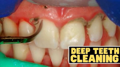 "In this tooth cleaning video, Dr. Sami reviews how teeth are cleaned at the dentist. What is the difference between a teeth cleaning and a deep cleaning at the dentist? How much does a tooth cleaning cost? How much does a deep cleaning cost? What are the different tooth cleaning tools? How does the ultrasonic tool clean teeth? Should you buy a teeth cleaning kit? How does deep cleaning affect your gums? All these questions will be answered in..." ~Smile Influencers Dentist Cleaning Teeth, Teeth Cleaning Videos, Cleaning Teeth Plaque, Deep Cleaning Teeth, Teeth Cleaning Routine, Deep Teeth Cleaning, Teeth Problems, Dental Ideas, Tartar Teeth