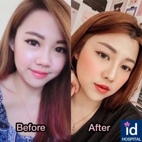 Carmen visited ID Hospital a while ago to get an Asian Rhinoplasty and the difference it has made to her image is really stunning 😘 #asianrhinoplasty #asianrhinoplastykorea #asianrhinoplastybeforeafter #idhospitalbeforeafter #koreanrhinoplasty #korearhinoplasty #bestrhinoplastyinkorea #rhinoplastybeforeafter #bestkoreaplasticsurgery #nosejob #koreannosejob Korean Nose Job Before After, Nose Job Before And After Asian, Korean Rhinoplasty Before After, Better Side Profile, Asian Rhinoplasty Before After, Asian Nose Job, Korean Nose Job, Korean Rhinoplasty, Asian Nose