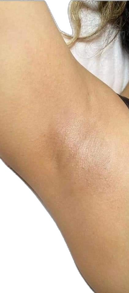 Other than having smooth, hairfree underarms for up to 4 weeks, did you know that one of the benefits of underarm waxing is the skin will be lighter? Well, it's true! Are you ready to experience the benefits of underarm waxing? 509-961-6555 #underarmwax #hairfree #bodywaxing #esthetician #hairless #yakima #bebare #fullbodywaxing #fromheadtotoe #bodywaxspecialist #nomorehair #bodywax #femalewaxing #malewaxing #barebliss #beauty #hairremoval #underarmwax #fullbodywax Clear Underarms Vision Board, Underarm Aesthetic, Under Arm Waxing, Clear Underarms, Clear Armpits, Lighter Underarms, Smooth Underarm, Clean Underarms, Female Waxing