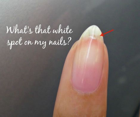 All you need to know about those white spot on your nails aka leukonychia #nails #beauty White Dots On Nails, White Marks On Nails, White Spots On Nails, White Patches, White Mark, My Nails, Nail Tutorials, White Nails, Spot On