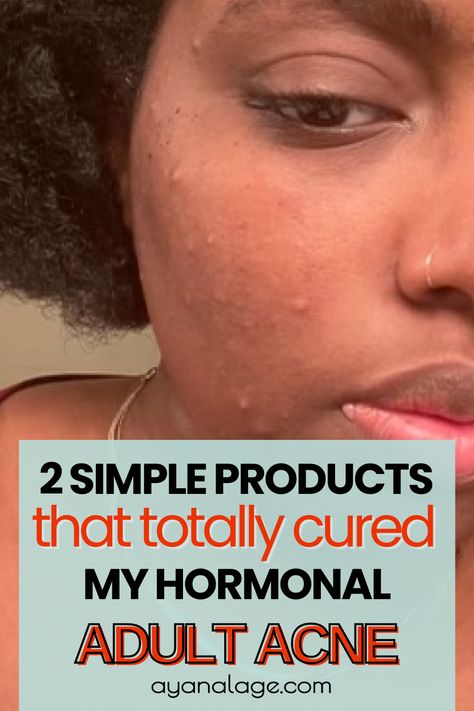 Under Skin Acne, Acne On Cheeks, Hormonal Acne Skincare Routine, Hormonal Acne Skincare, Comedonal Acne, Hormonal Acne Remedies, Cystic Acne Remedies, Acne Skincare, Acne Skincare Routine