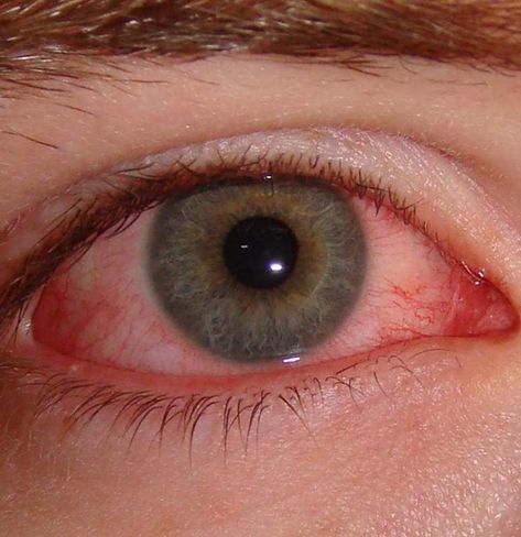 Pink Eye In Kids, Crusty Eyelashes, Eye Infections, Eye Pictures, Old Makeup, Photos Of Eyes, Pink Eye, Itchy Eyes, Viral Infection